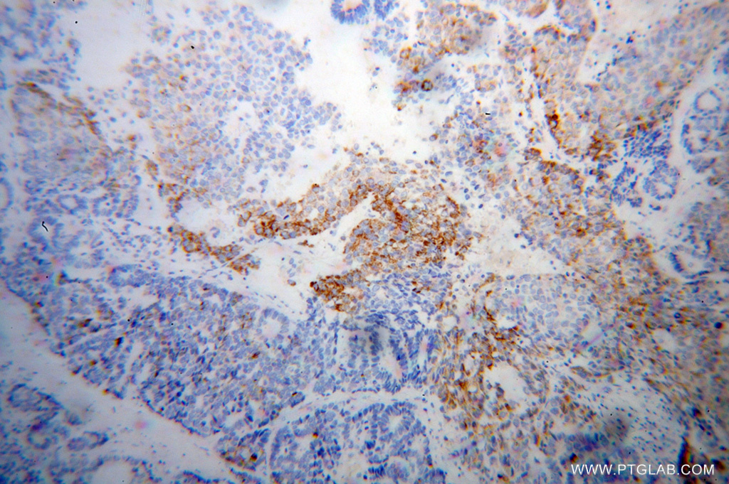 14901-1-AP;Liver cancer