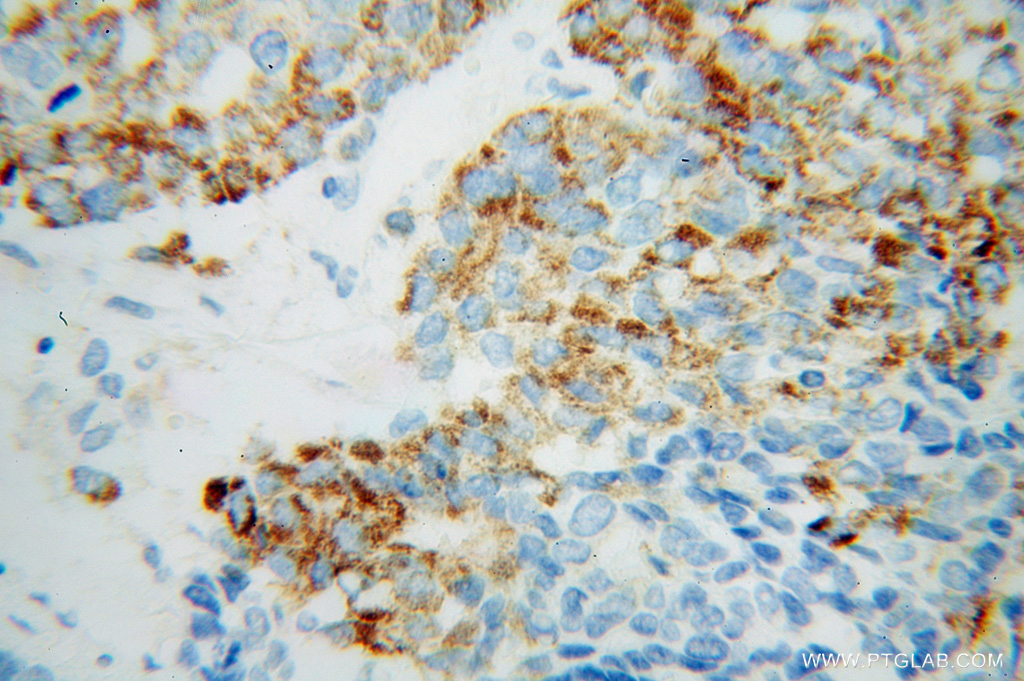 14901-1-AP;Liver cancer