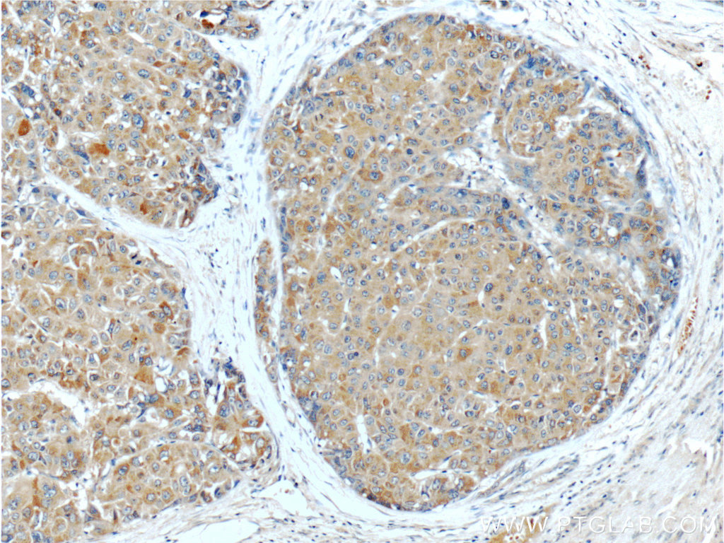 23029-1-AP;human liver cancer tissue