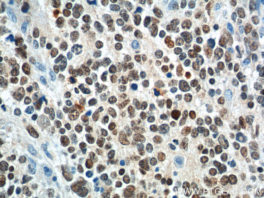 25276-1-AP;neuroblastoma tissue