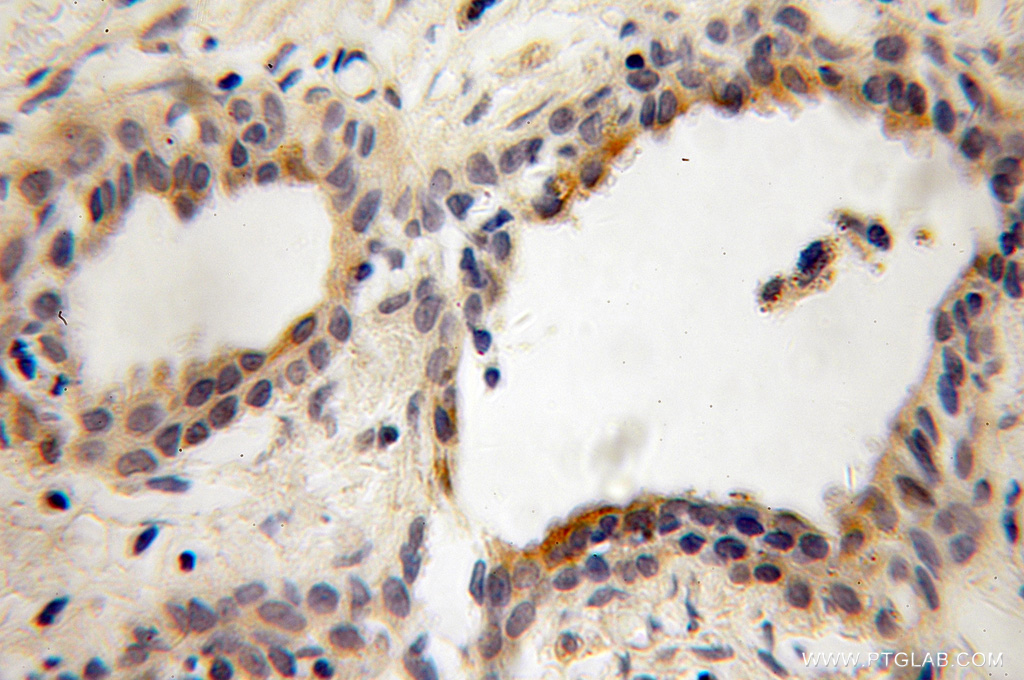 13110-1-AP;Prostate cancer