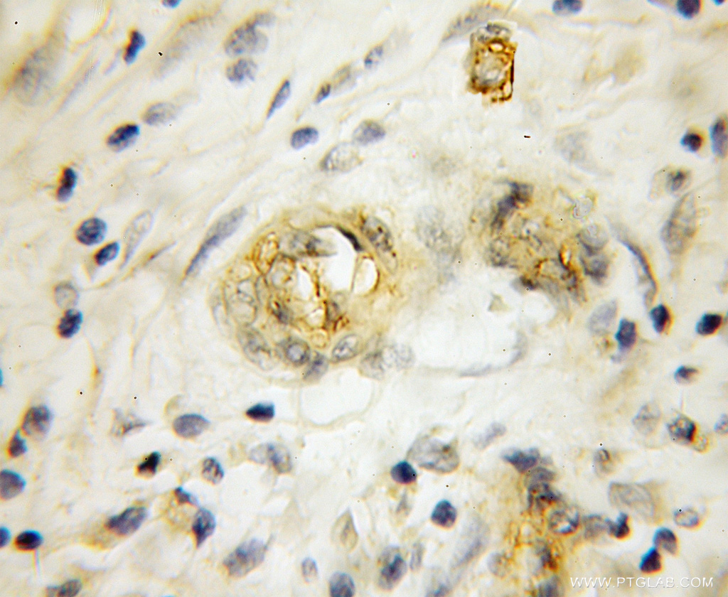 11949-1-AP;Pancreas cancer