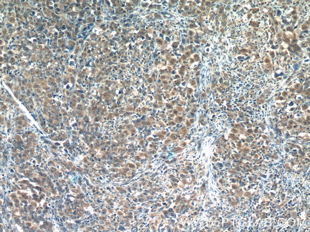 13290-1-AP;human lymphoma tissue