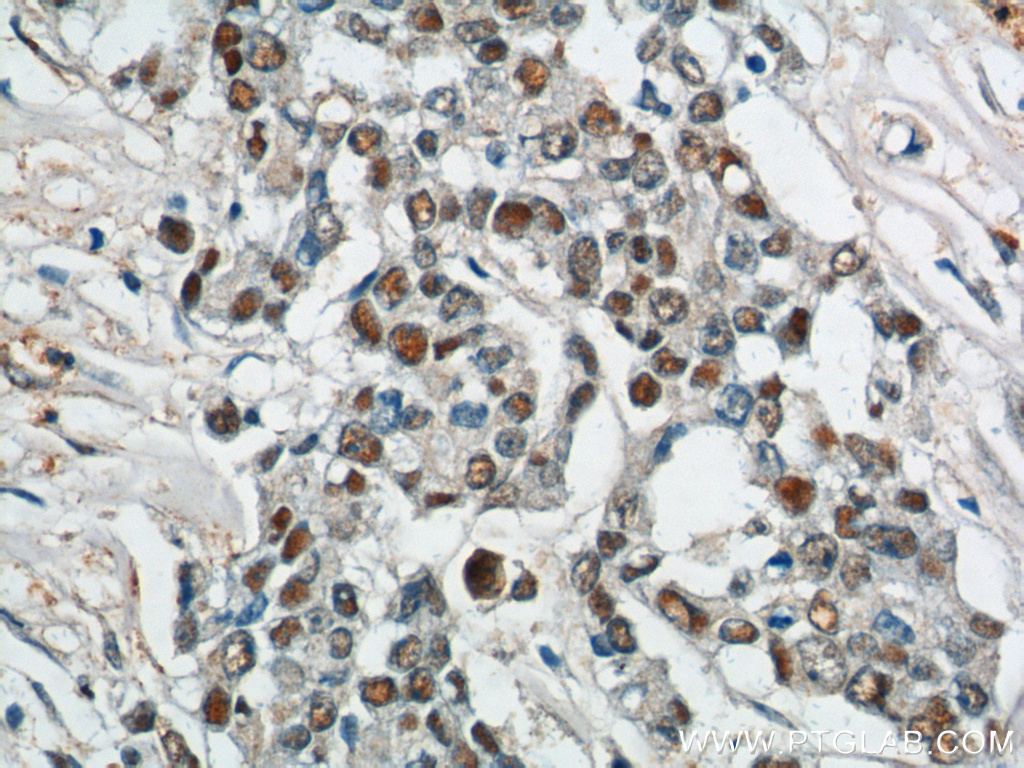 10229-1-AP;human colon cancer tissue