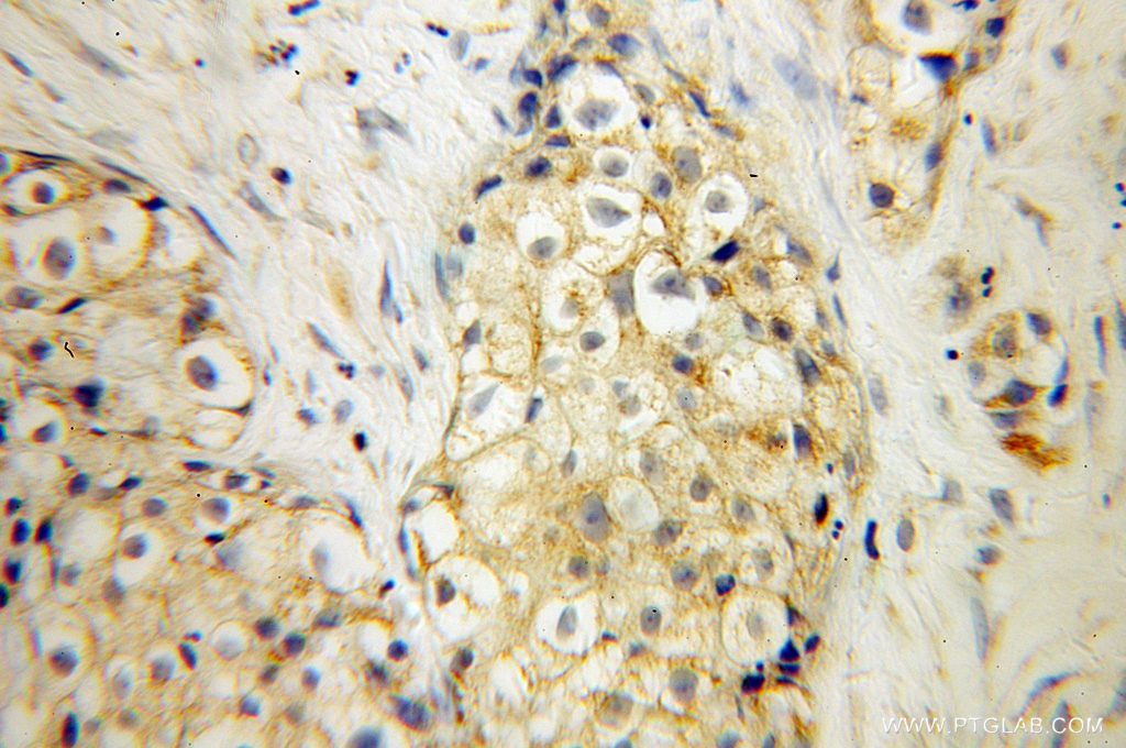 11811-1-AP;Lung cancer