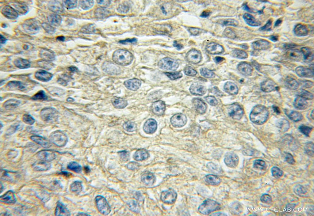 11078-1-AP;Lung cancer