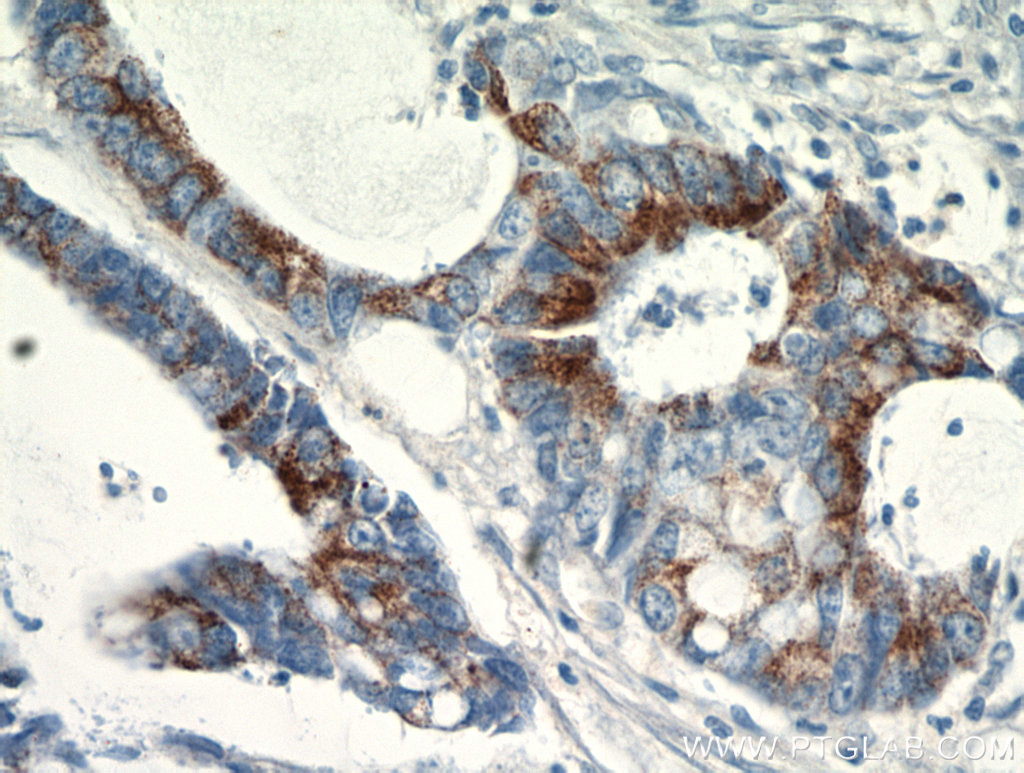 11742-1-AP;Colon cancer