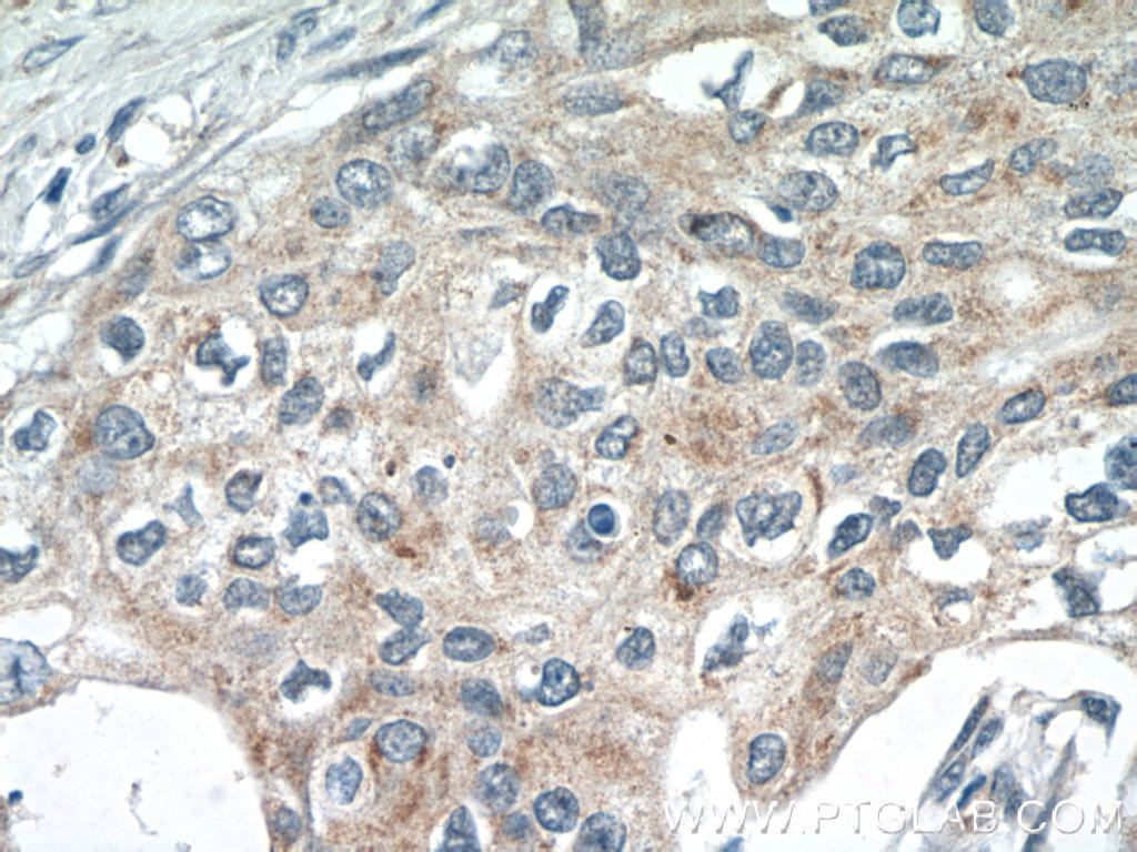 22765-1-AP;human cervical cancer tissue