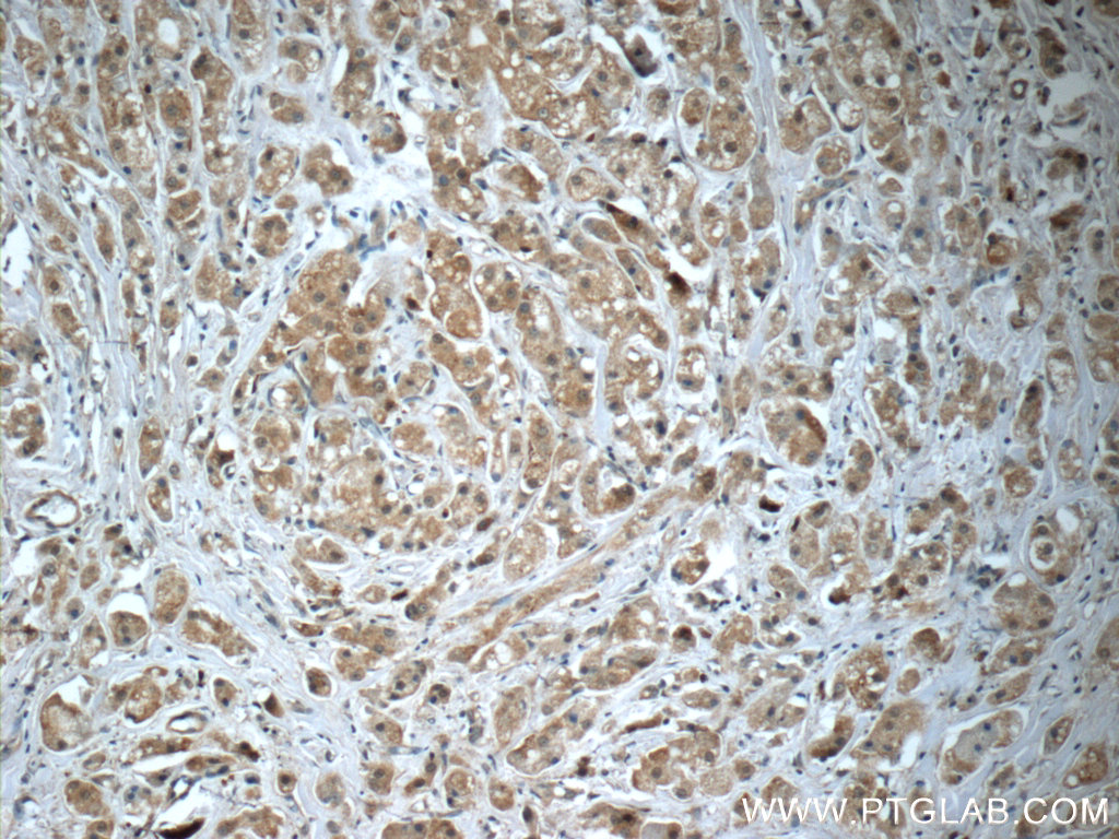 12544-1-AP;human breast cancer tissue