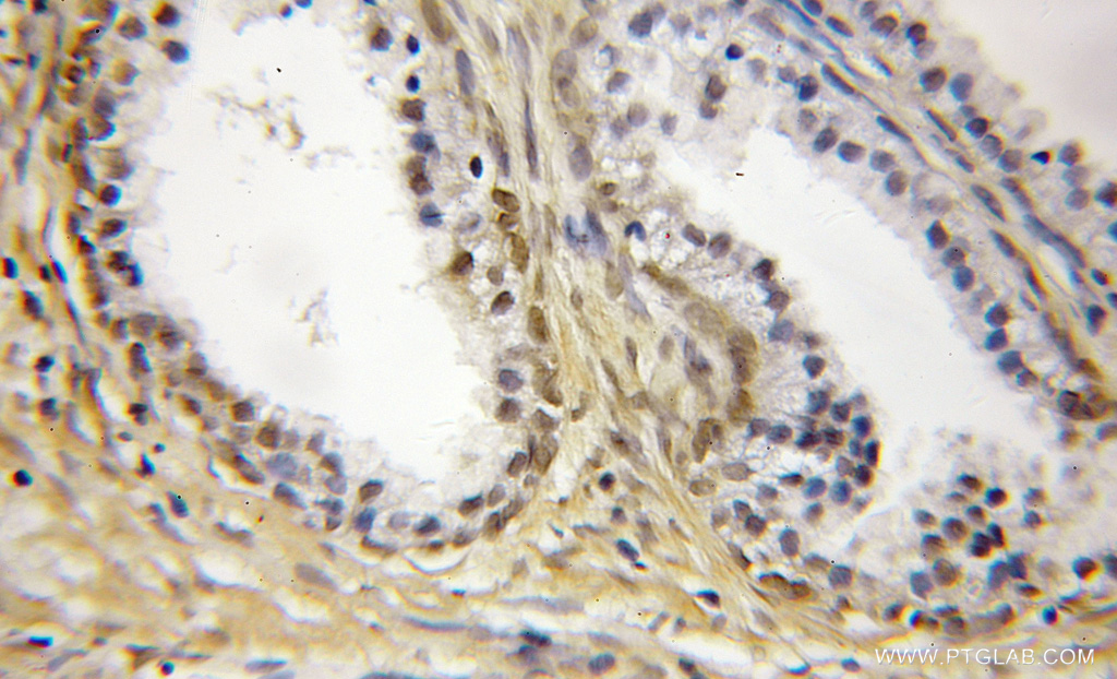 11817-1-AP;Prostate cancer