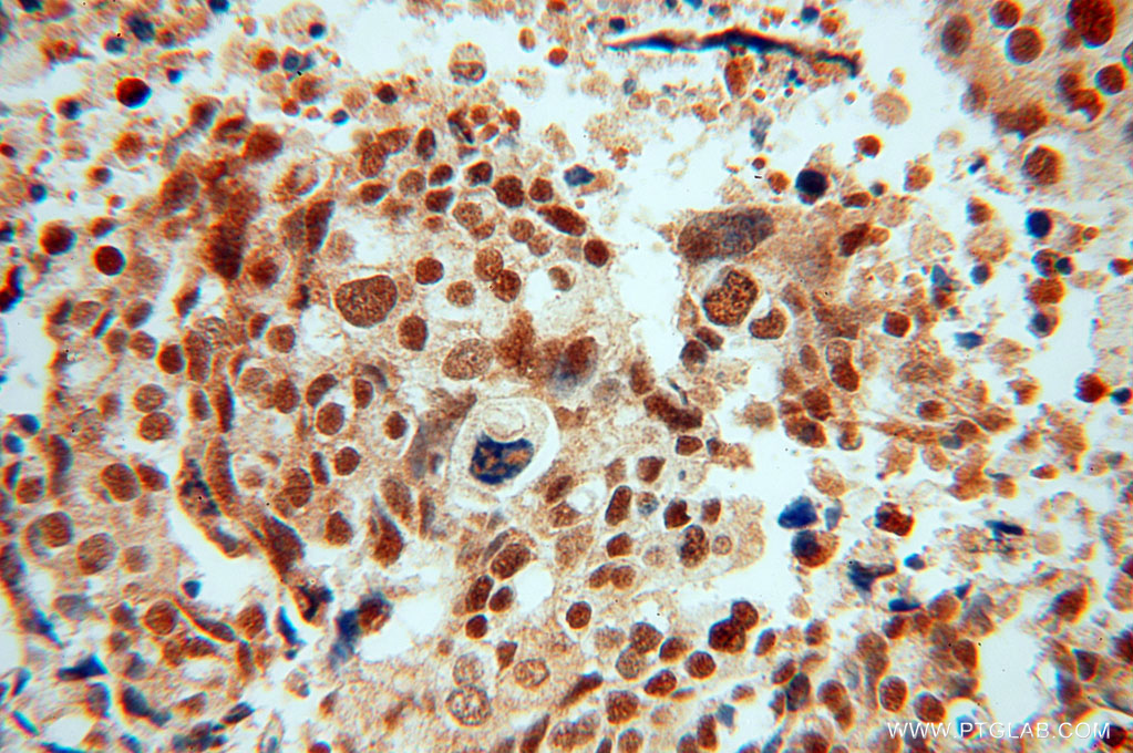 15696-1-AP;Ovary cancer