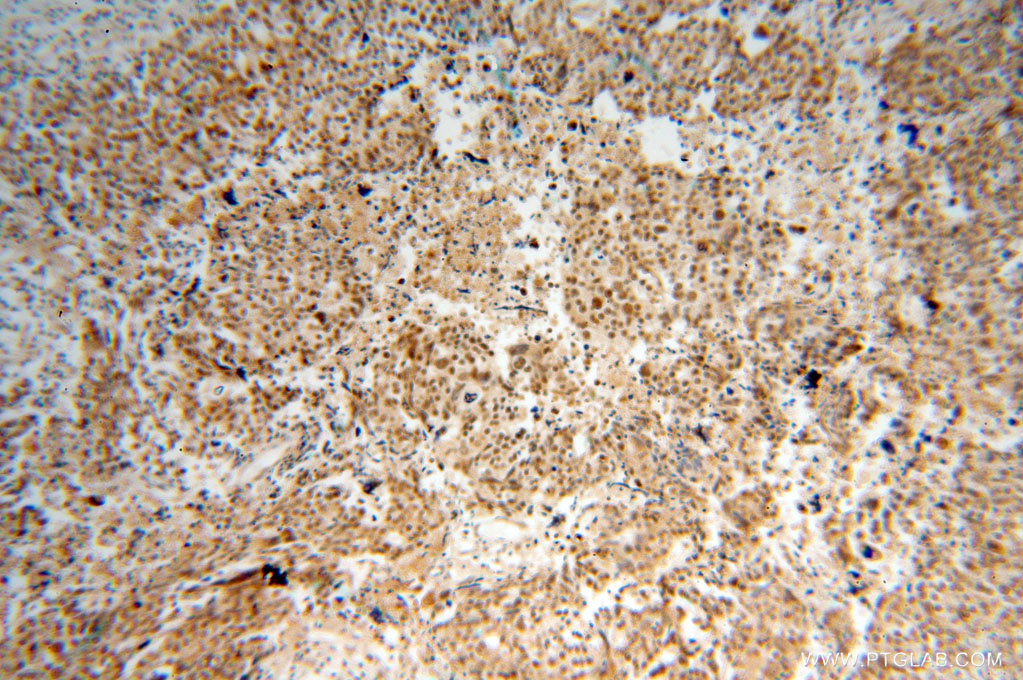 15696-1-AP;Ovary cancer