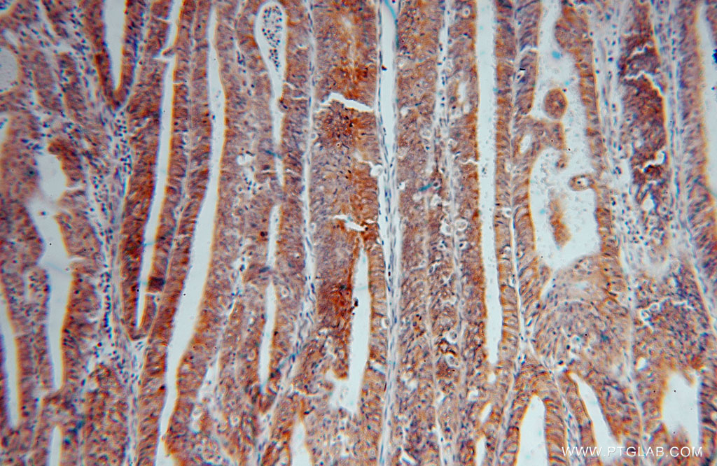 16013-1-AP;Endometrial cancer