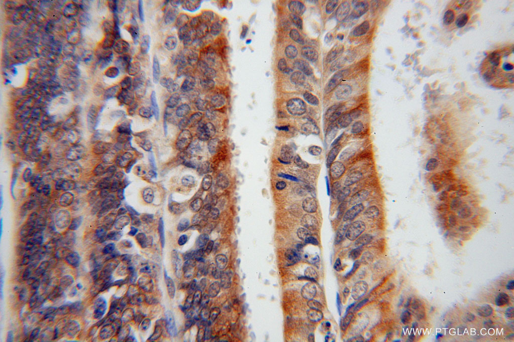 16013-1-AP;Endometrial cancer