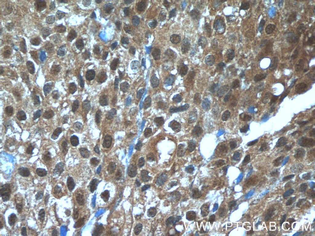 23237-1-AP;human breast cancer tissue
