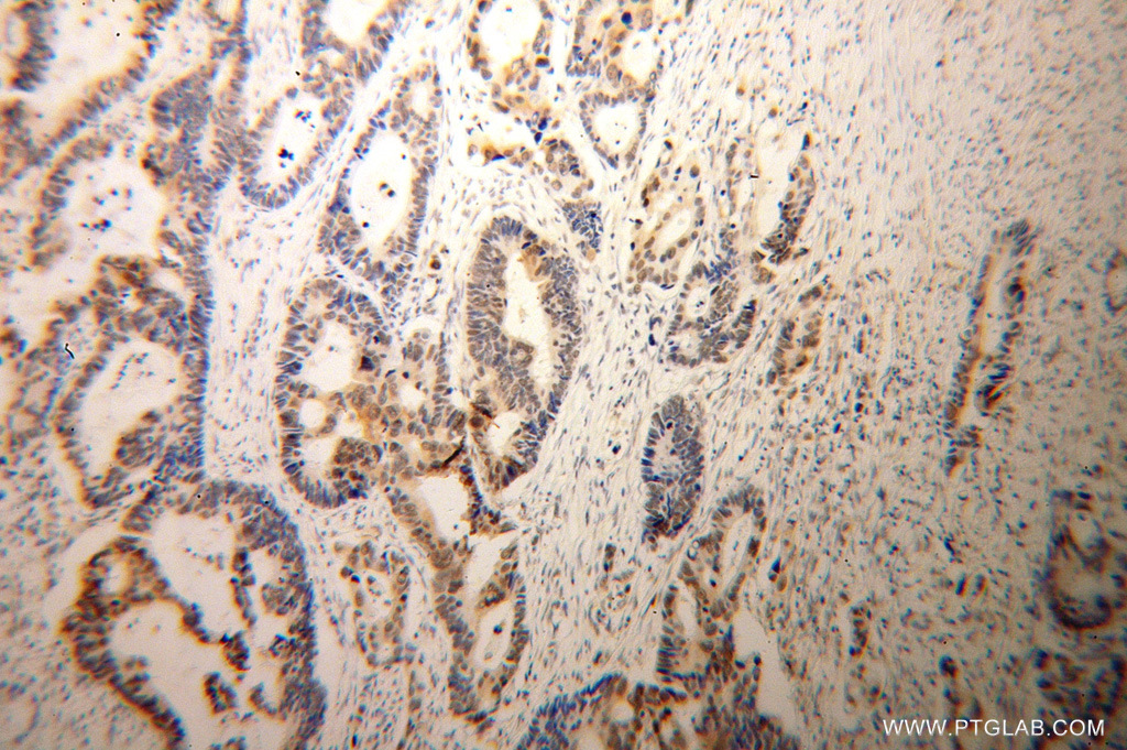 13547-1-AP;Colon cancer
