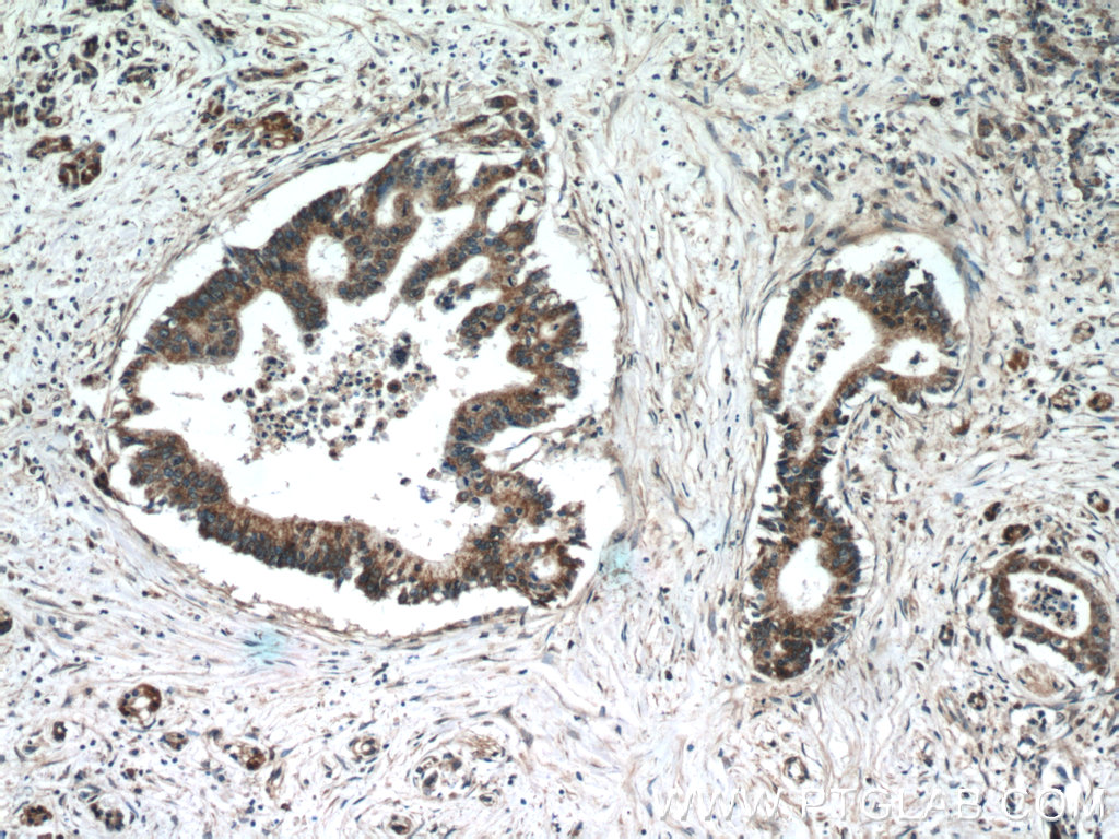 11981-1-AP;human pancreas cancer tissue