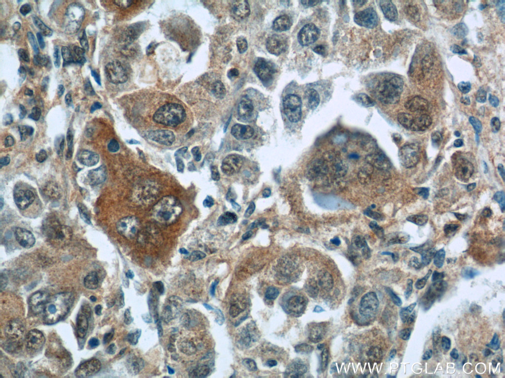 11580-1-AP;human liver cancer tissue