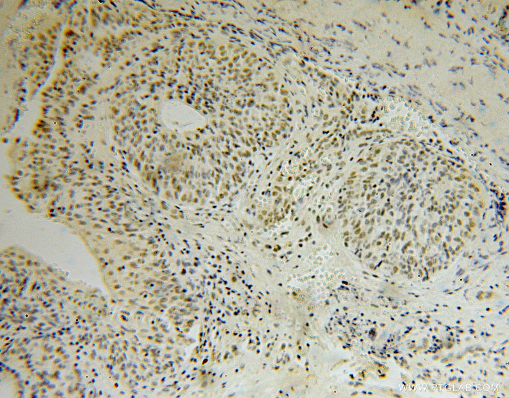 16203-1-AP;Colon cancer