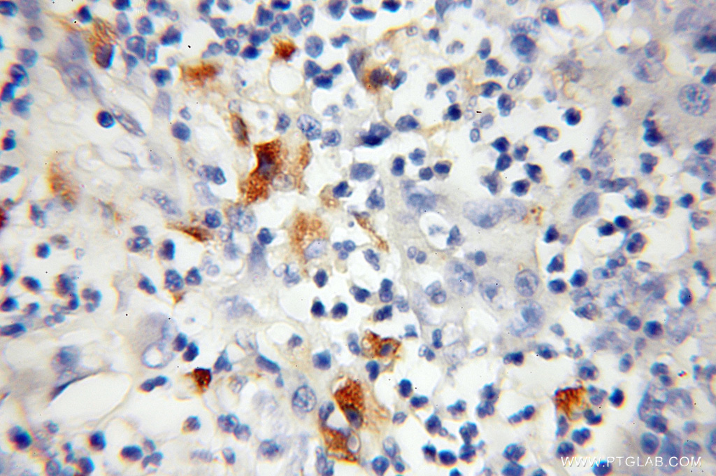 12196-1-AP;Colon cancer