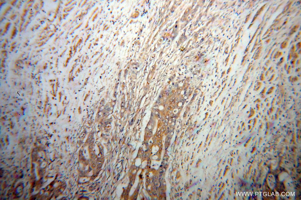 11081-1-AP;human colon cancer
