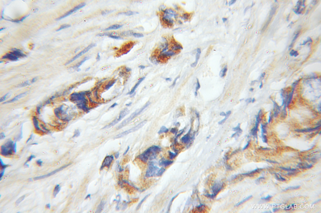 11624-1-AP;Prostate cancer