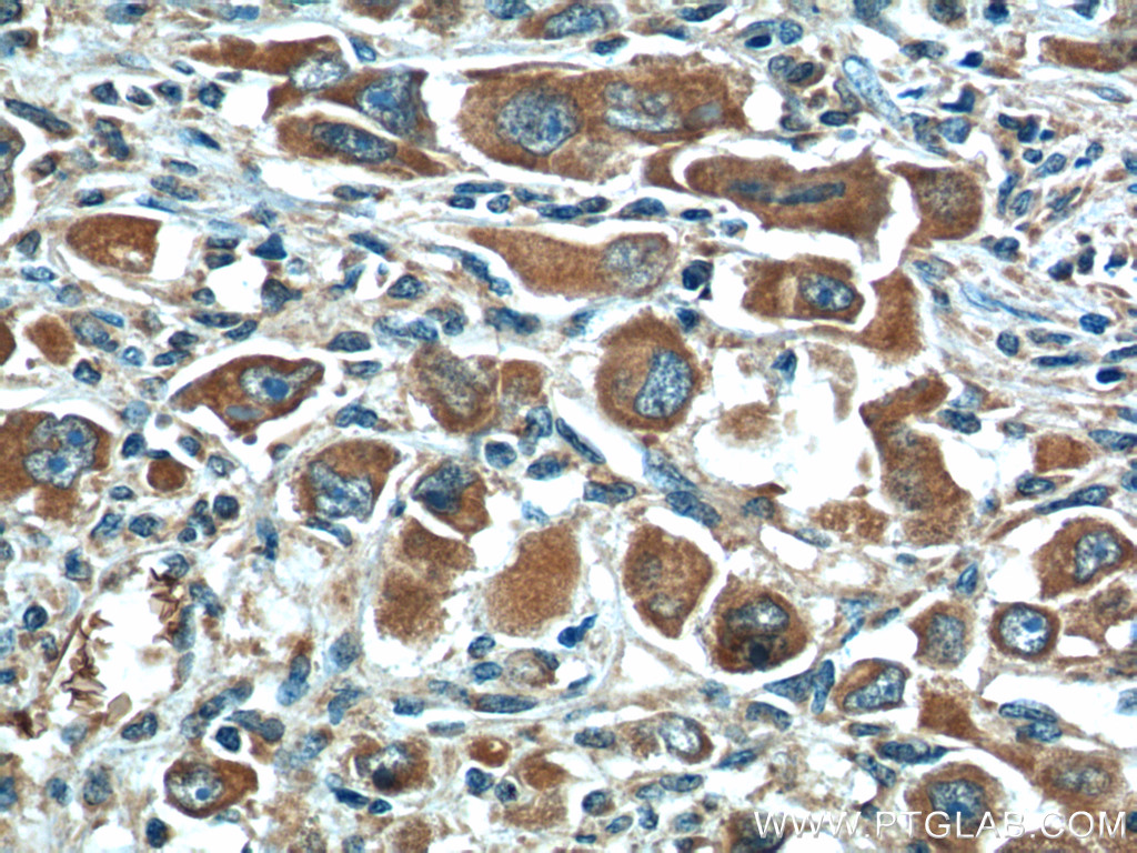24868-1-AP;human liver cancer tissue