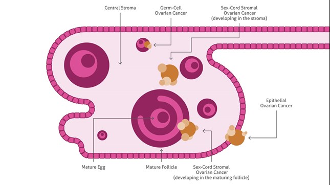 ovarian cancer epithelial cells)