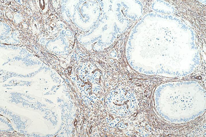 使用 Proteintech 的 Vimentin 小鼠单克隆抗体 (60330-1-Ig) 和抗小鼠/兔通用型自主全应用免疫组化试剂盒(PK10019) 对人胰腺组织进行免疫组织化学分析。