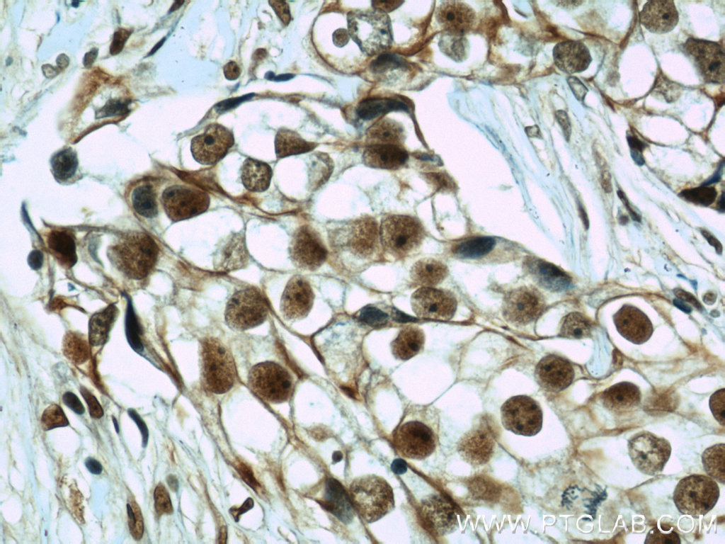 Immunohistochemical of paraffin-embedded human breast cancer using CIRBP antibody (10209-2-AP) at a dilution of 1:50 (40x objective)