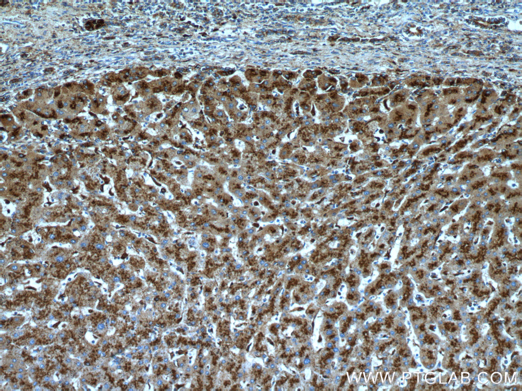 ihc staining of human hepatocirrhosis using 21327-1-ap