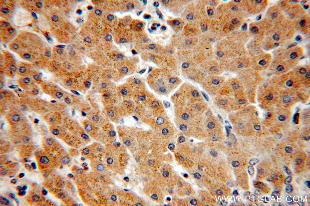 20012-1-ap;hepatocirrhosis