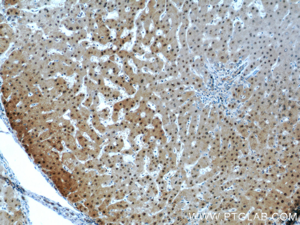 psmb5 antibody ihc human hepatocirrhosis tissue 19178-1-ap