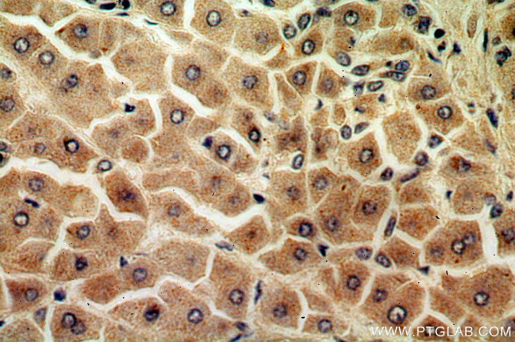 15285-1-ap;hepatocirrhosis