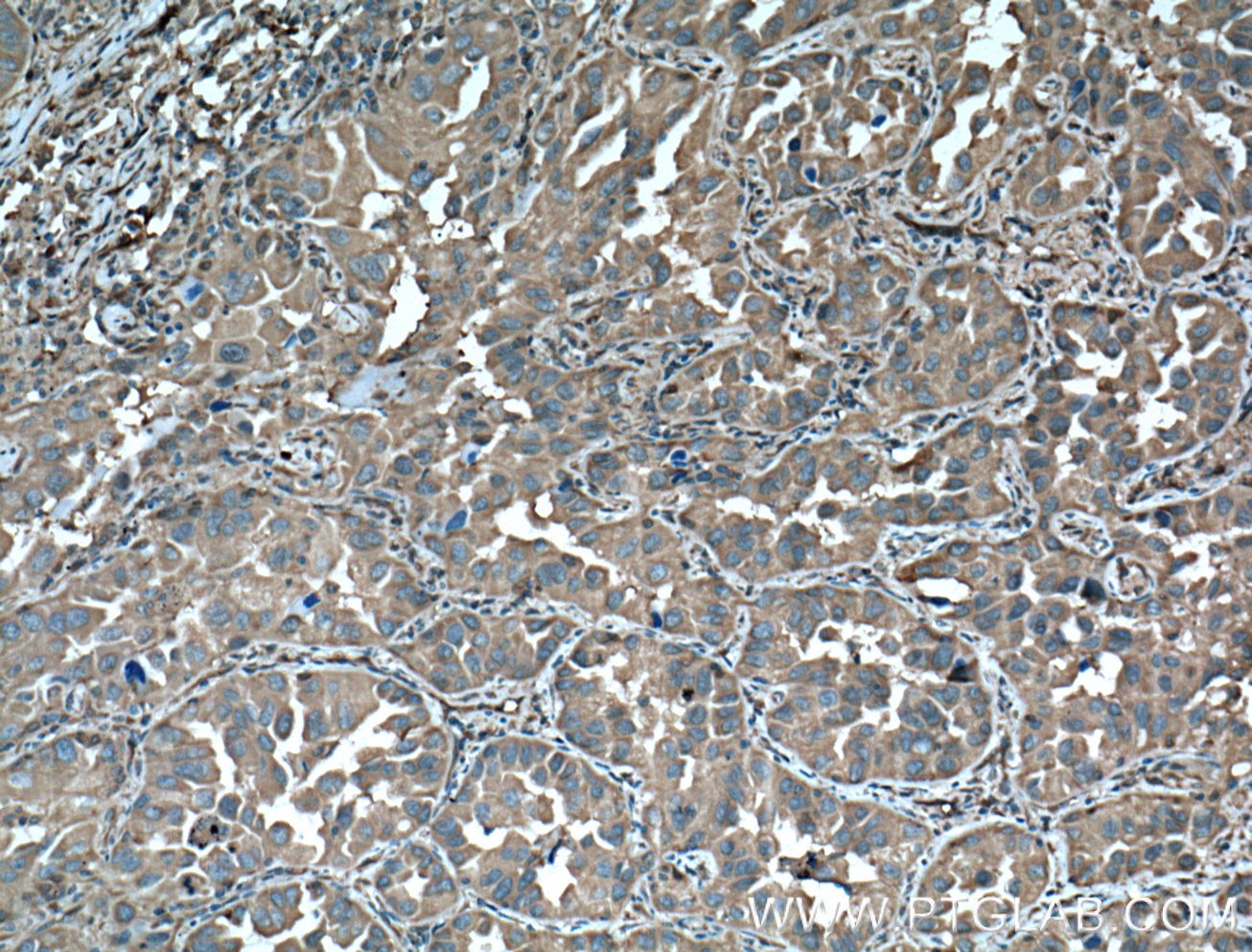 IHC staining of human lung cancer using 11648-2-AP