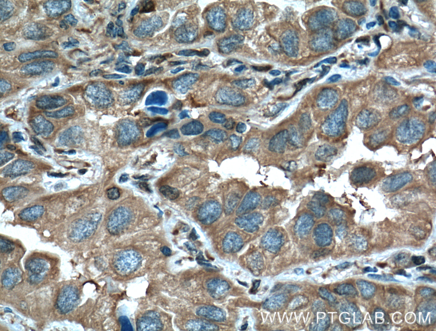 IHC staining of human lung cancer using 11648-2-AP