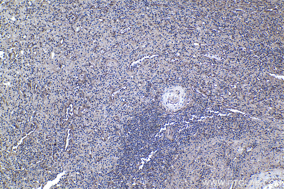 IHC staining of human colon cancer using 60246-1-Ig