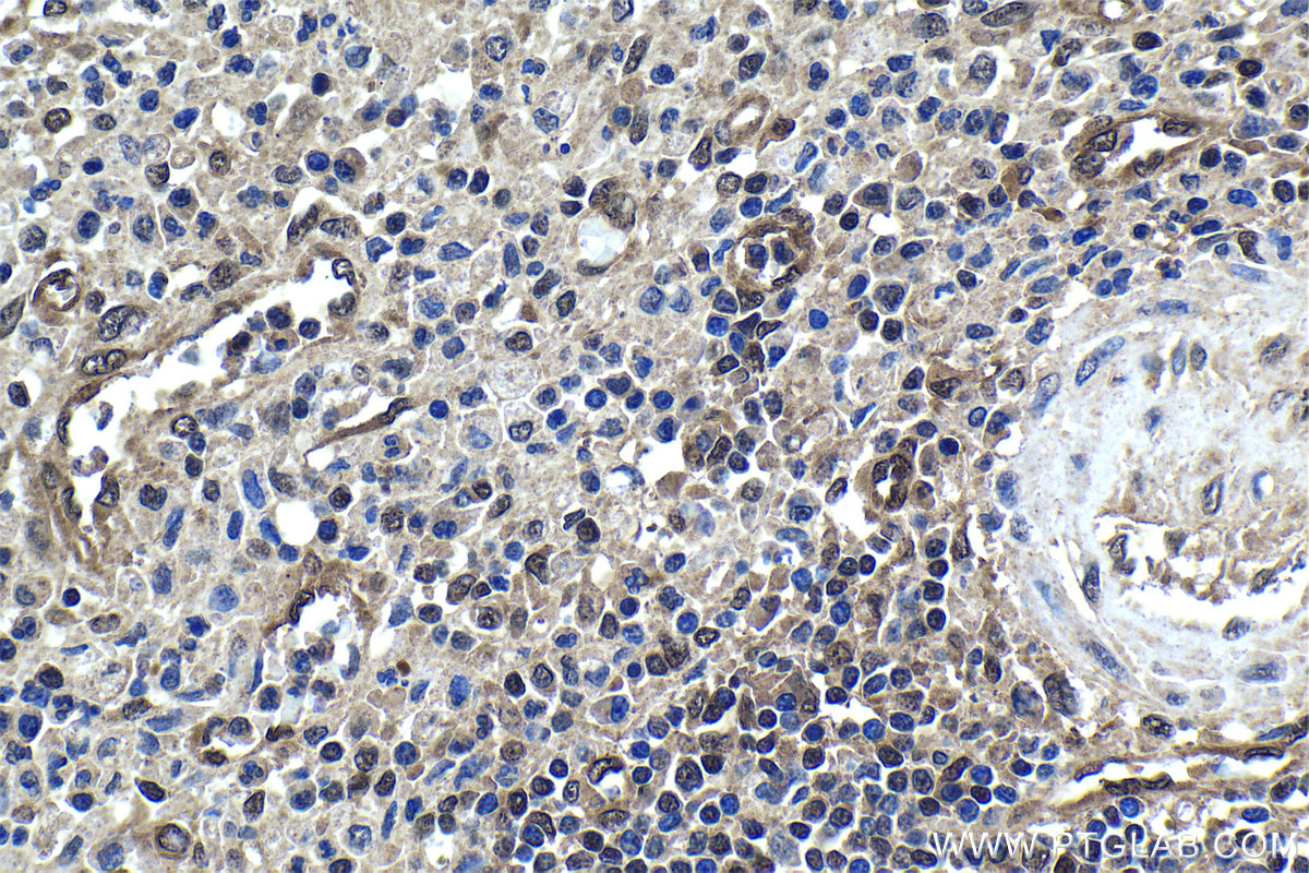 IHC staining of human colon cancer using 60246-1-Ig