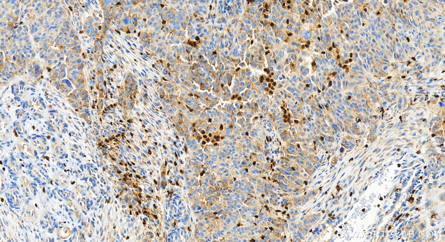 IHC staining of human ovarian  cancer using 83794-4-RR