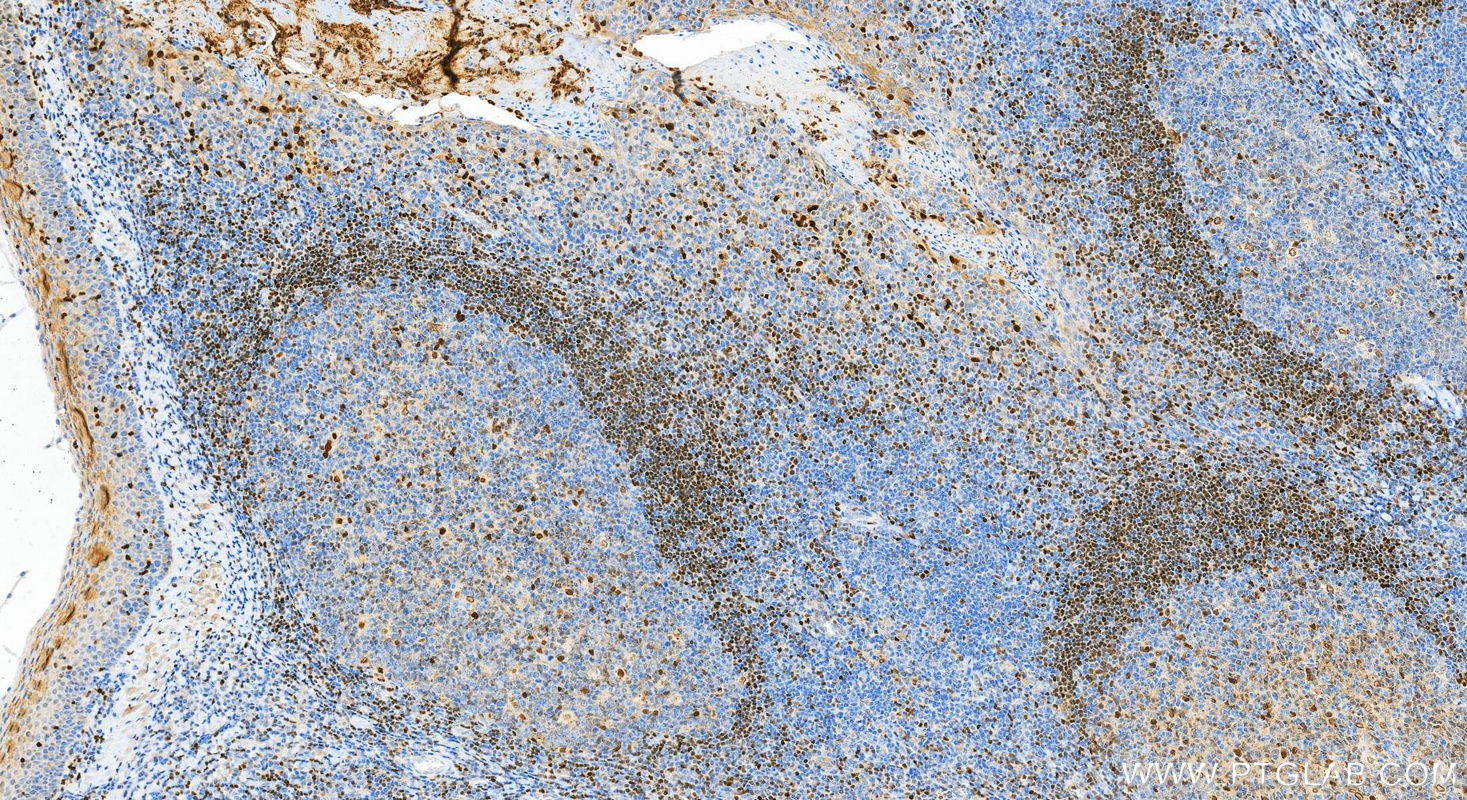 IHC staining of human tonsillitis using RMX00080 IHC staining of human tonsillitis using RMX00080