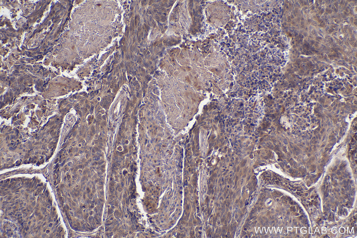 IHC staining of human lung cancer using 26550-1-AP
