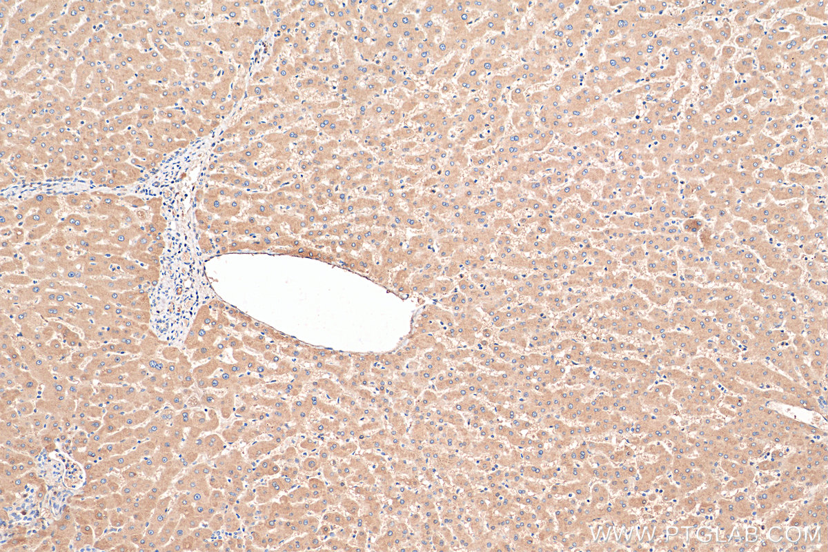 IHC staining of human hepatocirrhosis using 14181-1-AP