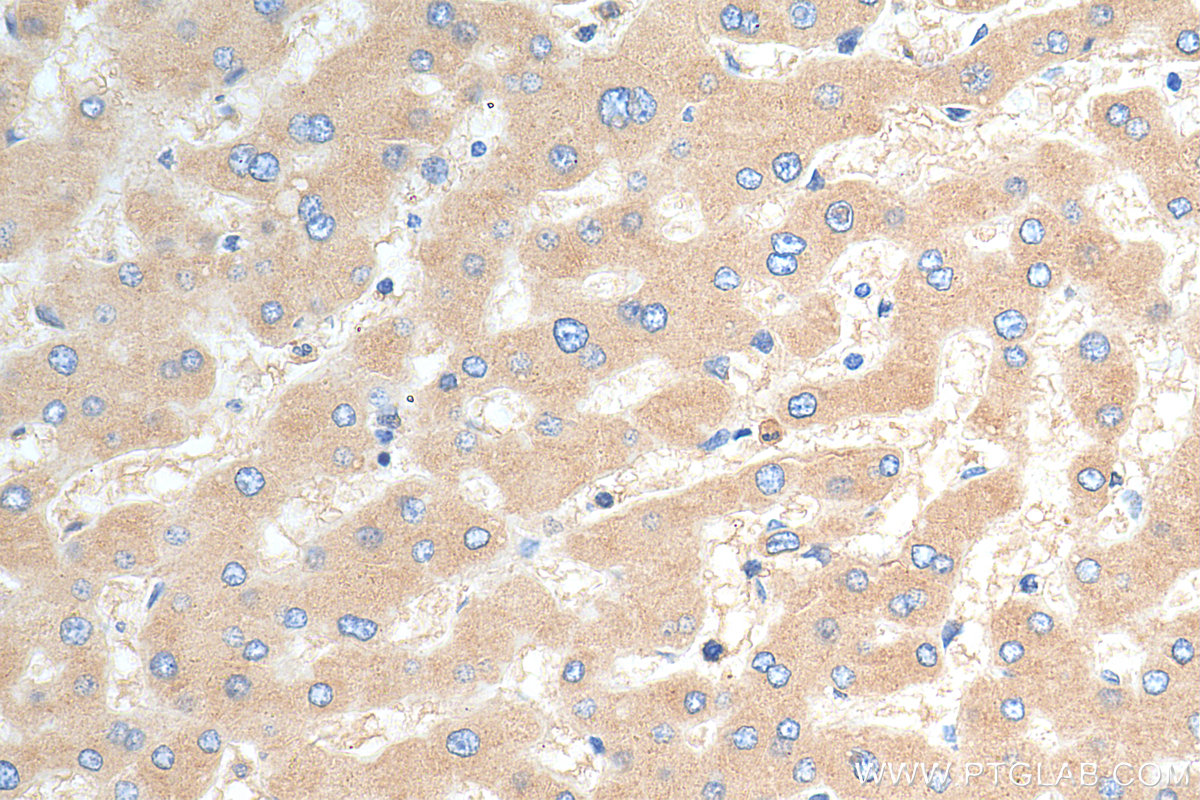 IHC staining of human hepatocirrhosis using 14181-1-AP