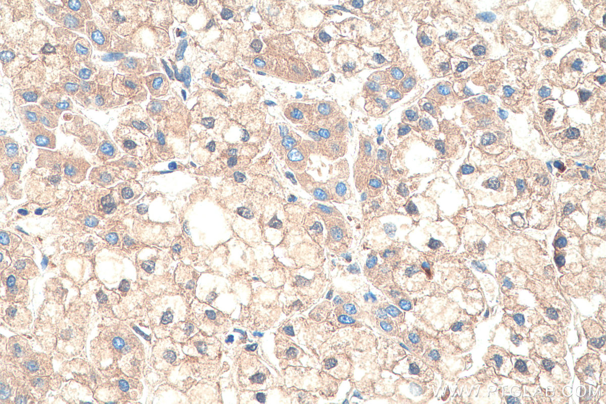 IHC staining of human liver cancer using 66126-1-Ig IHC staining of human liver cancer using 66126-1-Ig