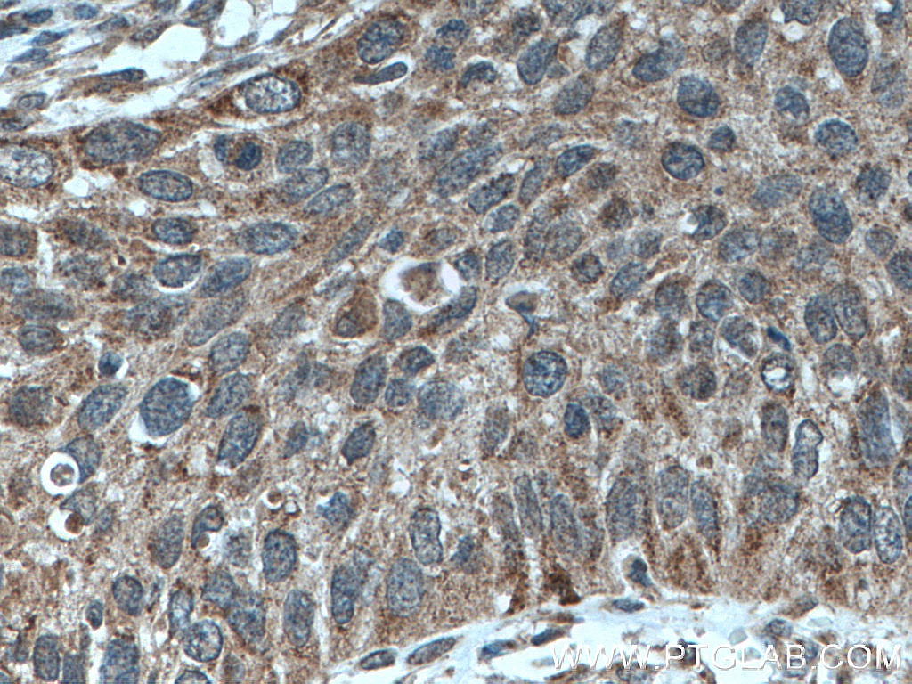 IHC staining of human cervical cancer using 12392-1-AP