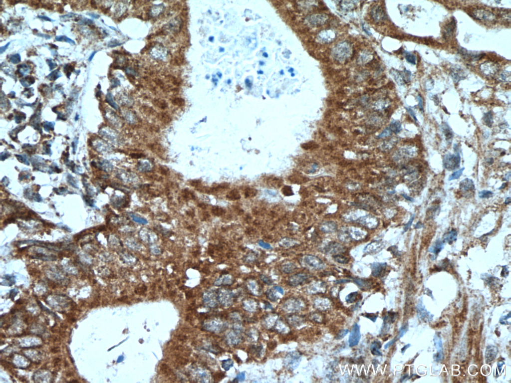 IHC staining of human stomach cancer using 22670-1-AP