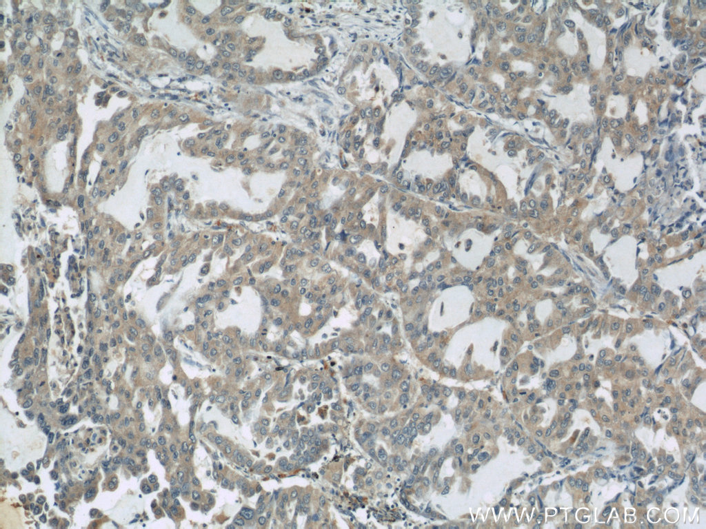 IHC staining of human lung cancer using 22696-1-AP