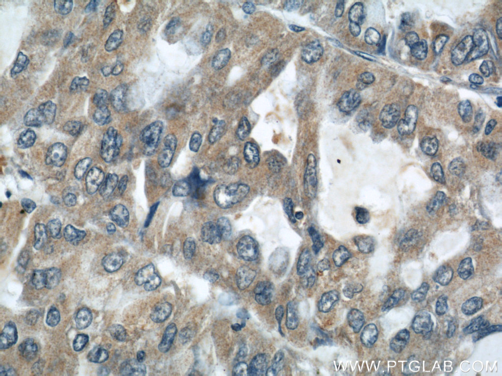 IHC staining of human lung cancer using 22696-1-AP