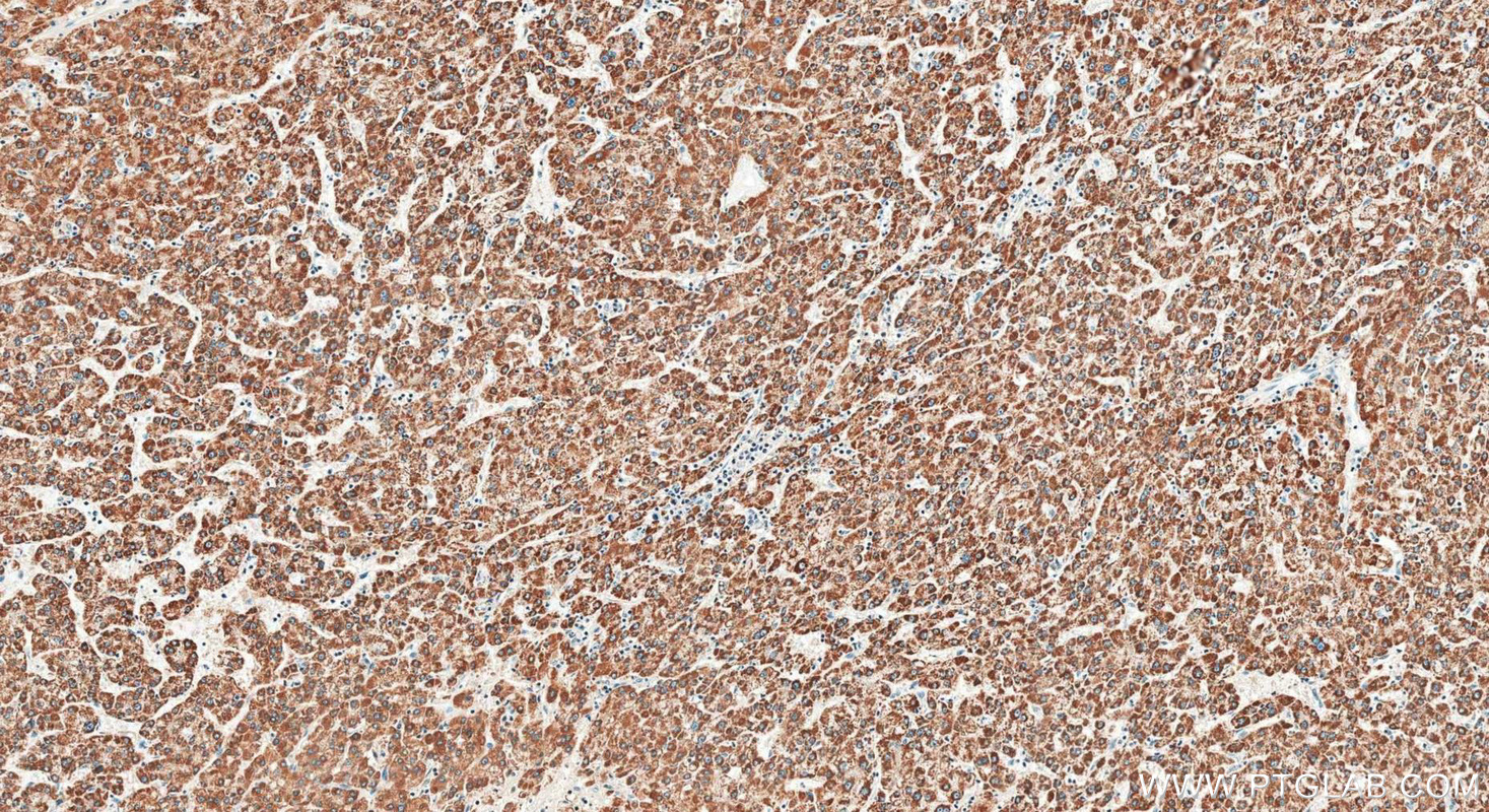 IHC staining of human liver cancer using 29354-1-AP