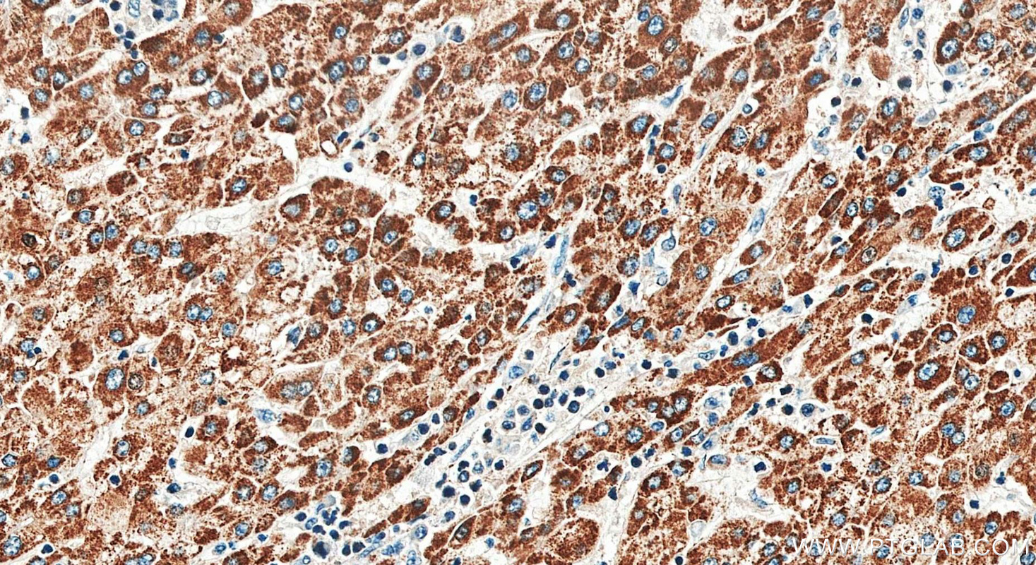 IHC staining of human liver cancer using 29354-1-AP
